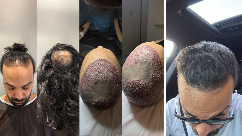 Hair transplant Before/After Results